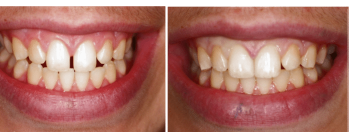 before and after photos of tooth bonding for gaps between front teeth