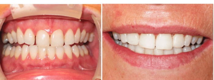 second before and after photos of tooth bonding for gaps between front teeth