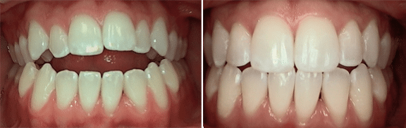 Invisalign in Atlanta, GA before and after