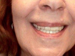 After snap-on-smile treatment in Sandy Springs, GA