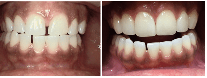 Real Results With Porcelain Veneers