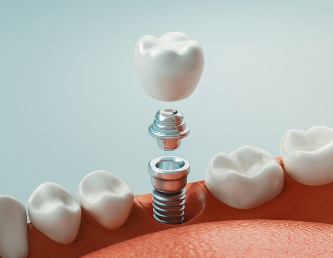 Dentures Atlanta, GA dental implants