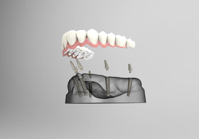 All-On-Four dental implants in Sandy Springs