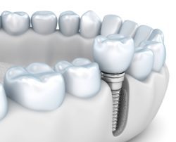 jawbone health with dental implants in Sandy Spring Georgia