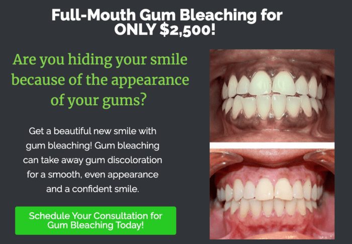 Full-Mouth Gum Bleaching ONLY $2500