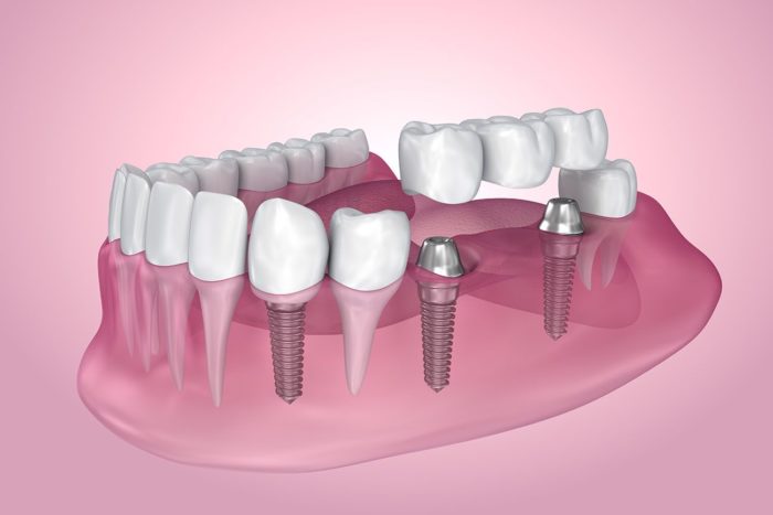 multiple dental implants Sandy Springs Georgia