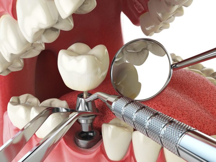 dental implant procedure Sandy Springs Georgia